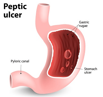 stomach ulcers